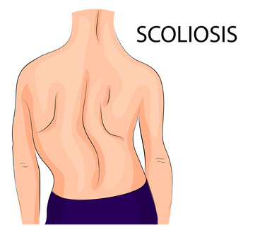 back-scoliosis-of-the-fourth-degree-